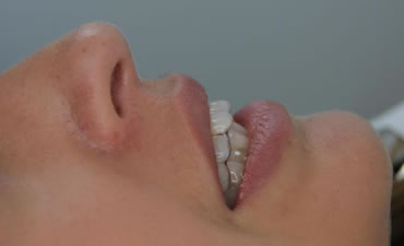 No Extractions