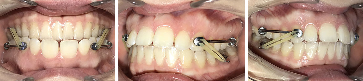 Bite Correction Treatment